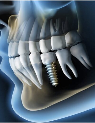 Ayelen : Clínica Dental en Chillán especializada en ortodoncia e implantes